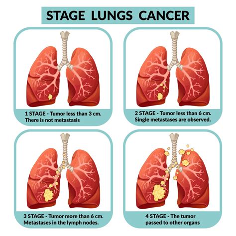 Spridd lungcancer stadie 4